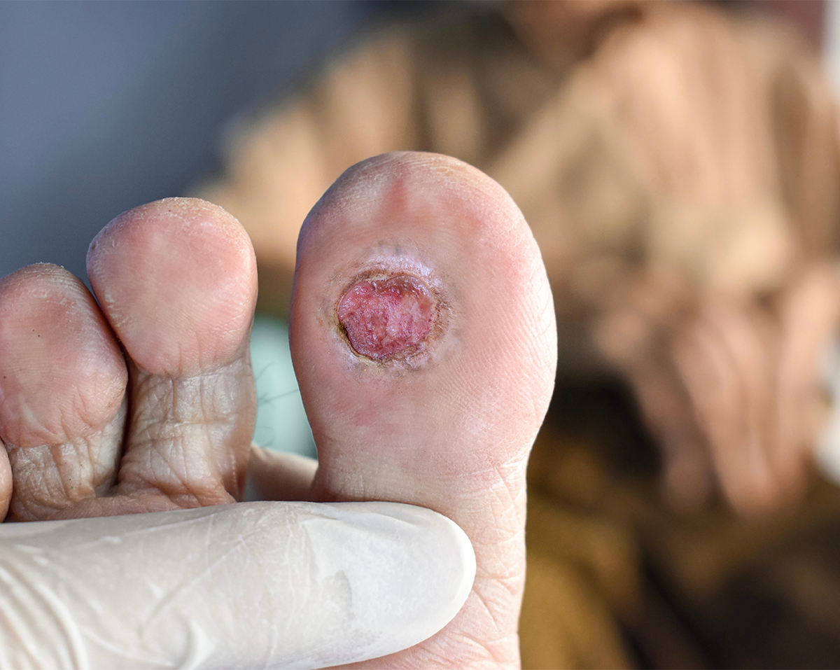 placental membrane therapy for diabetic foot ulcers