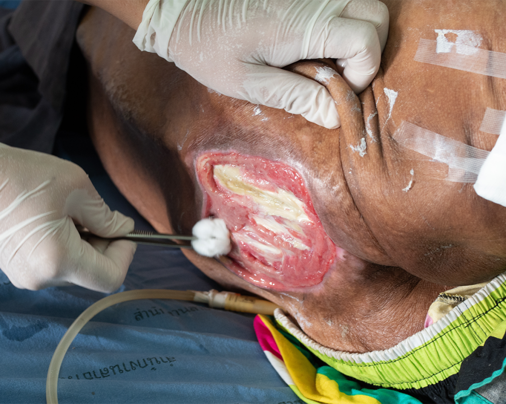 The Treatment of Chronic Pressure Ulcers with a Human Keratin Matrix. Symposium on Advanced Wound Care Fall 2023